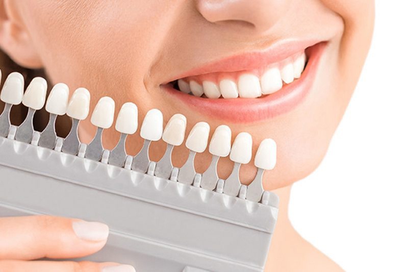 Tổng quan về trám răng thẩm mỹ